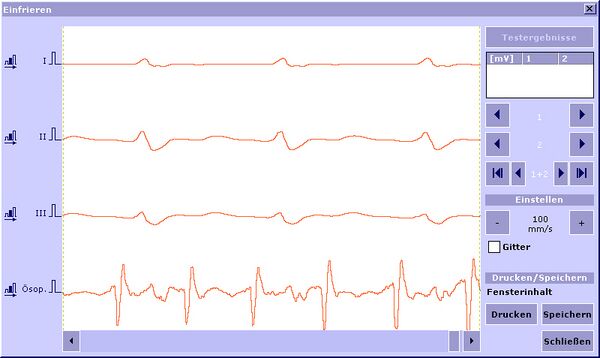 Esophageal left atrial electrogram recording to detect supra-ventricular tachycardias using the ICS3000 programmer (BIOTRONIK GmbH, Berlin, Germany).