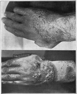 An introduction to dermatology (1905) blastomycosis.jpg