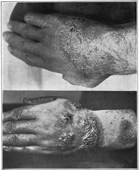 File:An introduction to dermatology (1905) blastomycosis.jpg