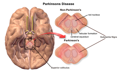 Blausen 0704 ParkinsonsDisease.png