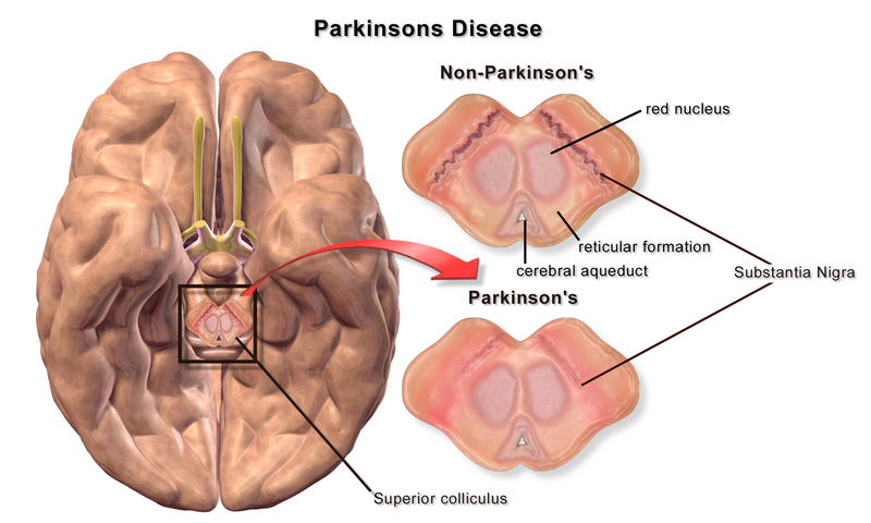 File:Blausen 0704 ParkinsonsDisease.png