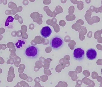 Carcinocythemia - malignant tumour cells in peripheral blood (cropped v1).png