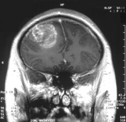 Glioblastoma - MR coronal with contrast.jpg