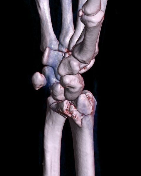 File:3D-rendered CT of Barton's fracture.jpg