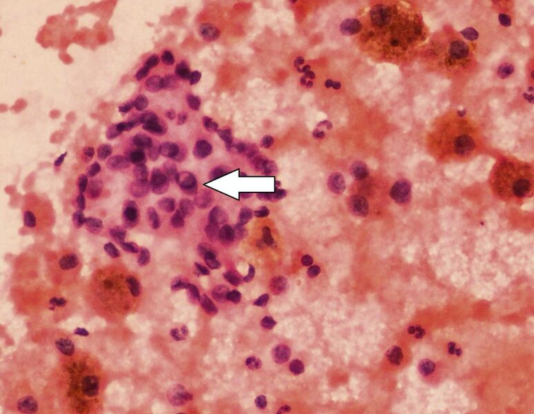 File:Thyroid cytopathology of Bethesda category V with intranuclear cytoplasmic inclusion.jpg