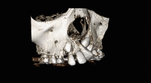 Alveolar cleft CT.gif