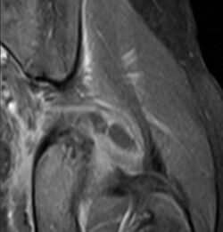 Cor post gad MRI Tropical pyomyositis.JPG