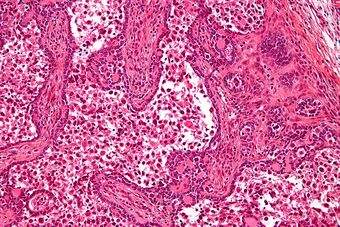 Gonadoblastoma - b - high mag.jpg