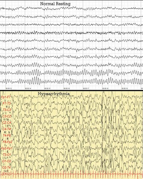 File:Human EEG Comparison.jpg