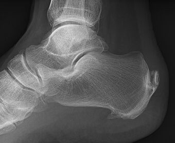 Achilles insertional calcific tendinosis.jpg