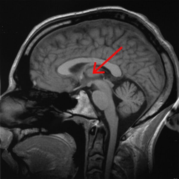 File:Brain chrischan thalamus.jpg