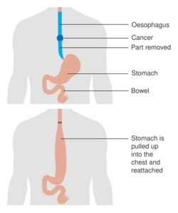 Diagram showing before and after a total oesophagectomy CRUK 105.svg