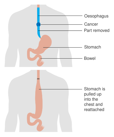 File:Diagram showing before and after a total oesophagectomy CRUK 105.svg