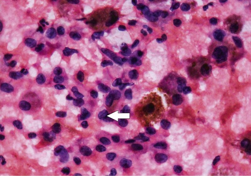 File:Thyroid cytopathology of Bethesda category V with nuclear groove.jpg