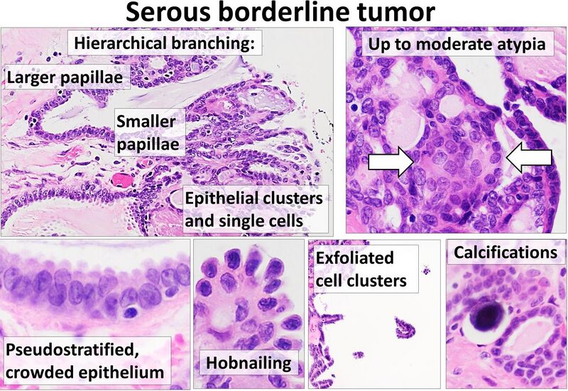 File:Histopathology of ovarian serous borderline tumor.jpg