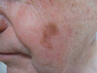 Photograph of lentigo maligna melanoma.jpg
