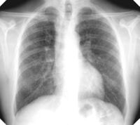 Xray of lungs