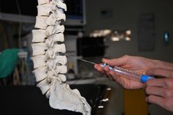 Epidural needle insertion between the spinous processes of the lumbar vertebrae.jpg