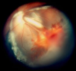 Exudative retinopathy and vitreos hemorrhage in cerebroretinal microangiopathy with calcifications and cysts.jpg