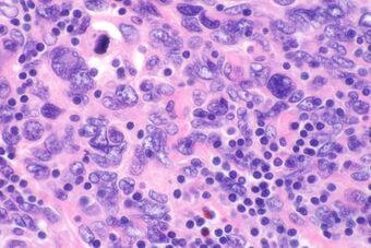 Follicular dendritic cell sarcoma -- very high mag.jpg