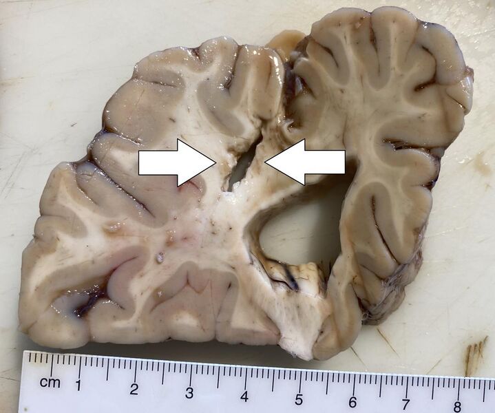 File:Gross pathology of an old cerebral stroke, annotated.jpg