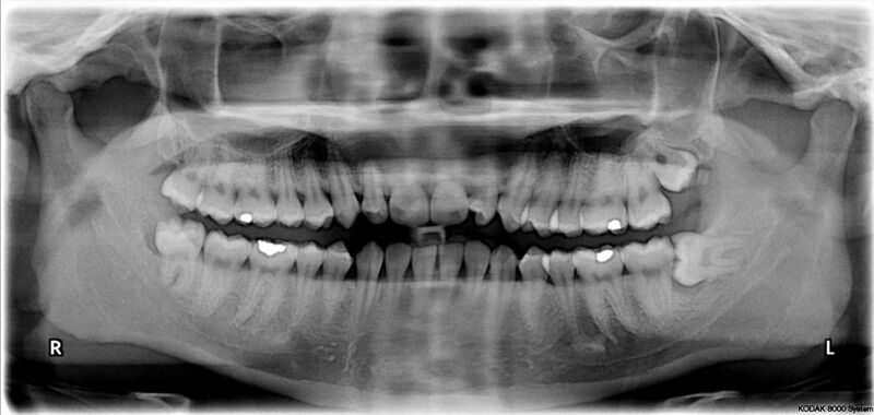 File:Impacted wisdom teeth.jpg