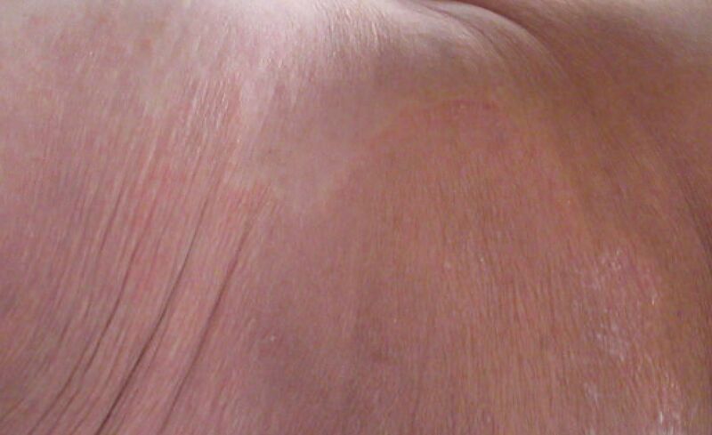 File:Tinea Corporis Right buttock wide.jpg
