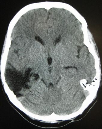 Traumaticbraininjury2010.jpg