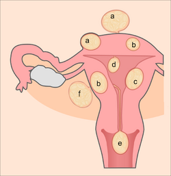 Uterine fibroids.png