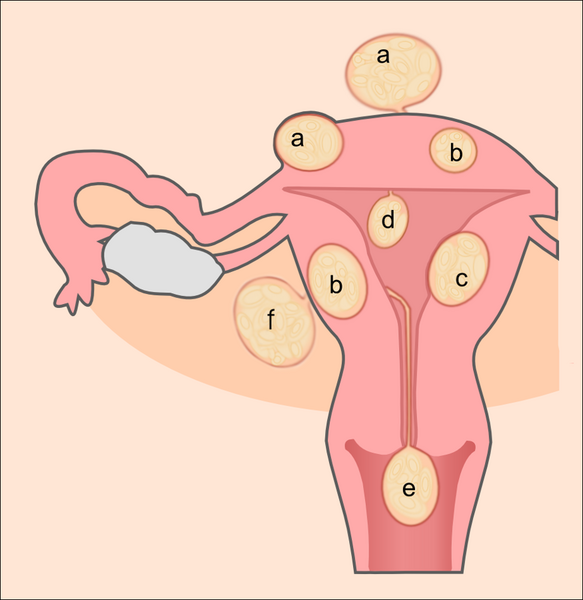 File:Uterine fibroids.png