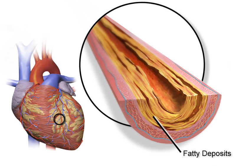 File:Blausen 0257 CoronaryArtery Plaque.png