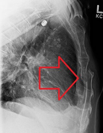 DisplacedSternalFracture.jpg