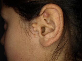 Accessory auricle.jpg