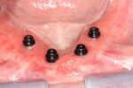 Four mandibular implants