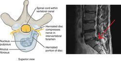 728 Herniated Disk.jpg