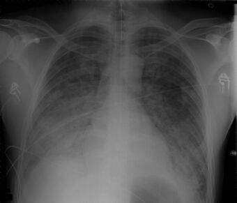 Chest Xray 40 yr old male acute respiratory distress syndrome as a complication of murine typhus. 13-1421-F1.jpg