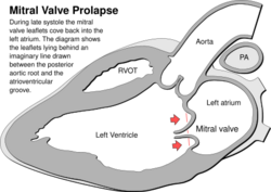 Heart mitral valve prolapse.svg