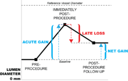 Late Loss Restenosis.png