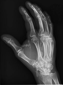 Oblique hand radiograph showing tumoral calcinosis