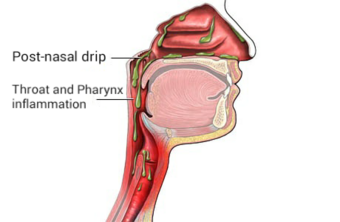 Post nasal drip en.png