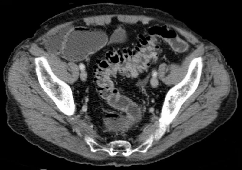 File:Sigmadivertikulose CT axial.jpg