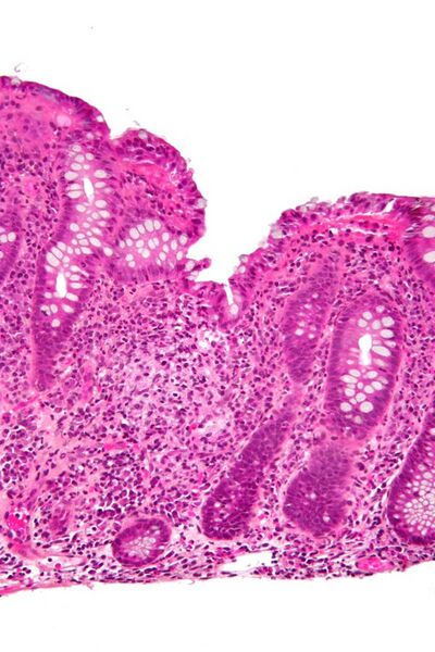 File:Colitis with granuloma high mag.jpg