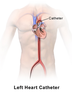 Left Heart Catheter.png