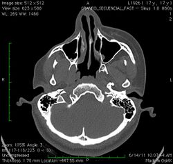 A CT image of the head of a 17-year-old girl with Parry–Romberg syndrome, showing atrophy of the subcutaneous tissue and underlying muscle, with no apparent involvement of the bone structure.