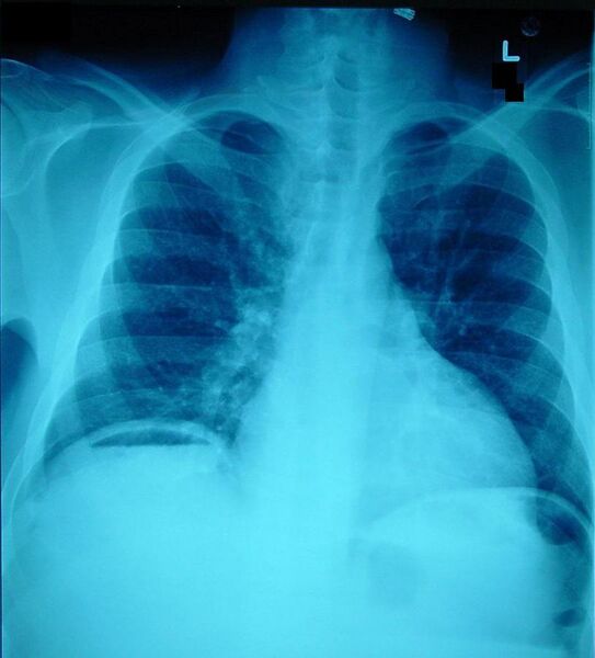 File:Pneumoperitoneum X-ray.jpg