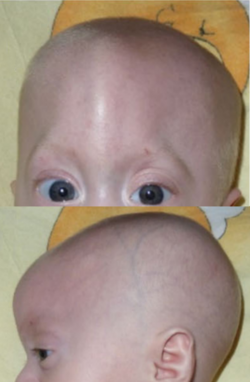 Trigonocephaly (2).png