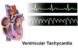 Ventricular Tachycardia.png