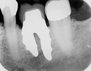 X-ray of root analogue dental implant two rooted left lower molar.jpg