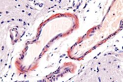 Cerebral amyloid angiopathy - very high mag.jpg