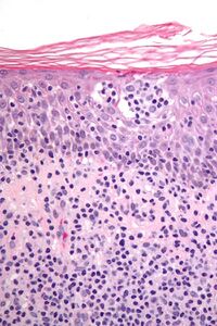 Cutaneous T-cell lymphoma - very high mag.jpg